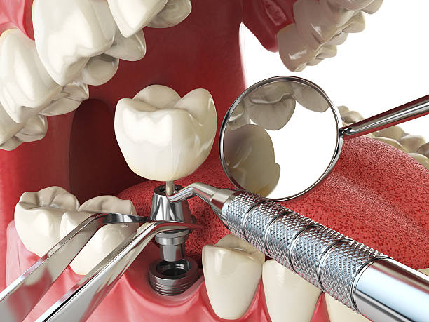 Best Emergency Root Canal Treatment in Vla Grove, IL